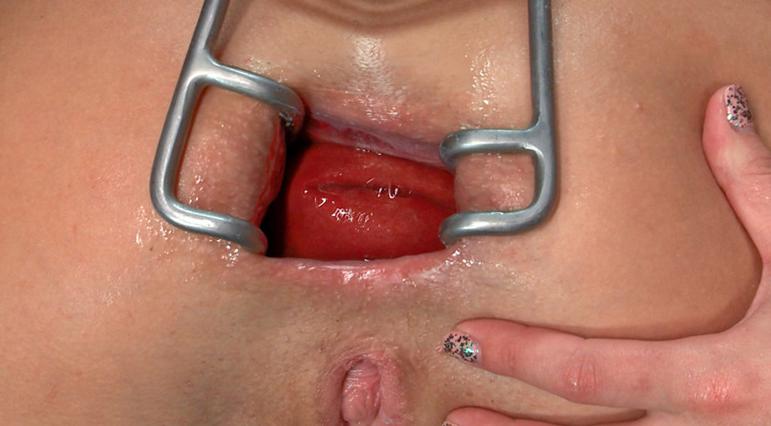 anal carcinoma in situ